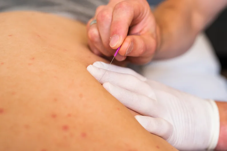Dry Needling bij spierklachten.